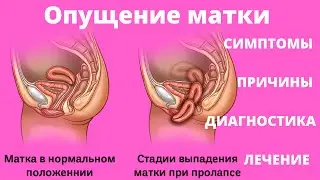 ОПУЩЕНИЕ МАТКИ (симптомы, причины, диагностика, лечение)