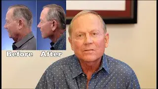 Deep Plane Facelift Surgery on Men | Before and After Photos With Review