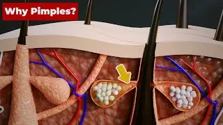 Why do we get PIMPLES? (3D Animation) #Shorts