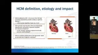 Update on HCM: Does Mavacamten Challenge Septal Reduction Therapy?