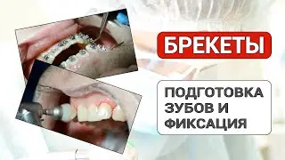 Брекеты – подготовка зубов к установке и фиксация