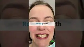 New Teeth in ONE DAY