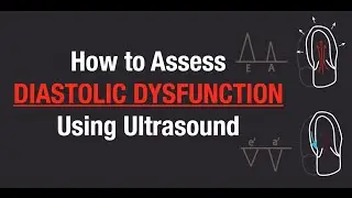 Diastolic dysfunction on Echocardiography with quiz  