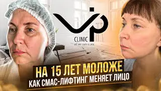 СМАС лифтинг. История пациента Веры 54 года.