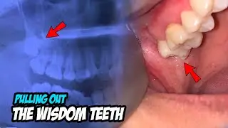 It’s very challenging to remove wisdom teeth that are all embedded.