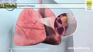 Treatment Options for Lung Cancer – CIMS Hospital