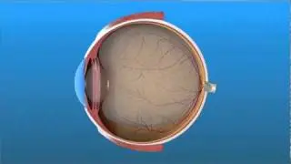 Cirugía de Vitrectomía para el Desprendimiento de Retina