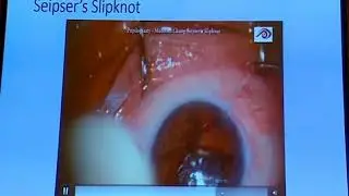 AIOC2018 - IC229 - Topic - iridodialysis repair and iris defect repair - AG.Chinnappa