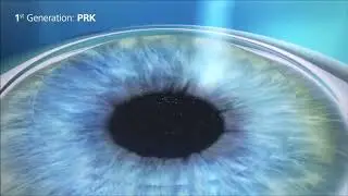 ФРК и СМАЙЛ (ReLEx SMILE) - сравнение методов лазерной коррекции зрения