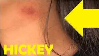 how to give someone a hickey fast and easy