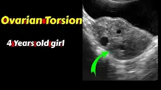 Ovarian Torsion  | Ultrasound Case | 4 years old girl