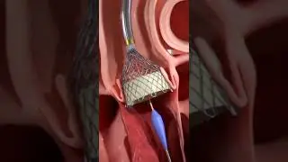 Transcatheter aortic valve implantation procedure (TAVI)