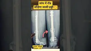 Rod ,Sariya In Fracture Treatment 💥 जांघ में सरिया रॉड #InterlockingNail #femur #femurfracture #bone