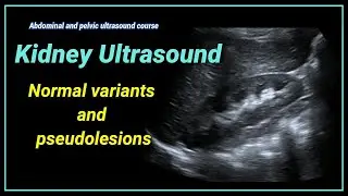 Kidney ultrasound  2- Normal variants and pseudolesions