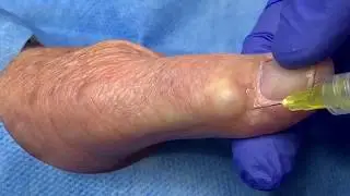 Ganglion Cyst (Jelly Doughnut Hole) Extraction