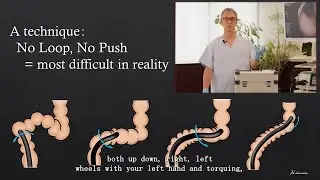 Colonoscopy Insertion Technique with Mikoto Model: How to avoid loops during colonoscopy?