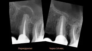 Вывод №4 Киста зуба - это не опухоль! Лечение кисты зуба под микроскопом. Имплант Киста зуба Антанян