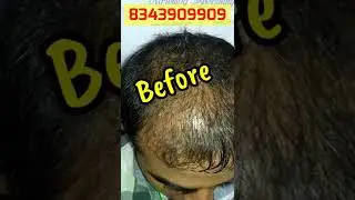 PRP Hair LossTreatment Before And After | #ytshorts #shorts