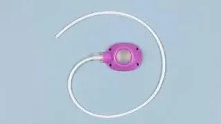 Insertion of a totally implantable vascular access device (TIVAD)