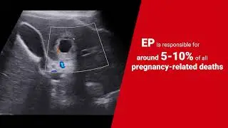 Topic in Spotlight - Ectopic Pregnancy