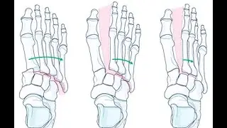 Lisfranc Injuries: Ioannis Stavrakakis MD, Crete, Greece