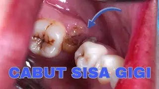 PROSES CABUT SISA GIGI | Dentist | Dokter Gigi Tri Putra