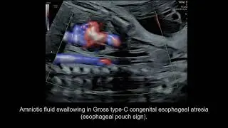 Retrotracheal space width is reduced in fetuses with suspected congenital esophageal atresia