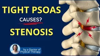 Stenosis, Psoas Muscle Tightness & Lower Back Pain | Causes