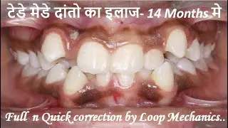 Quick Alignment of Teeth by T-loop technique I Difficult case for Clear Aligners I Magic of Braces I