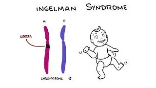 Angelman Syndrome