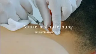 Muttermalentfernung bei Dermacare Wien