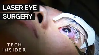 What It's Like To Get Laser Eye Surgery