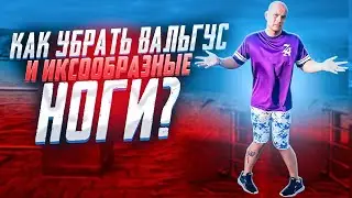 Как убрать вальгус стопы и иксообразные ноги?