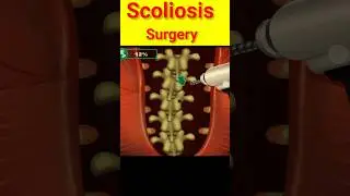 Scoliosis Surgery #3d #shortvideo #youtubeshorts #shorts