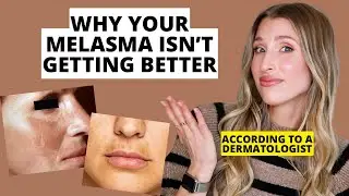 Dermatologist Shares Biggest Melasma Mistakes to Avoid | Dr. Sam Ellis