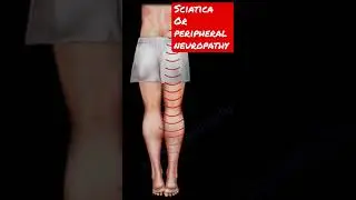 Peripheral neuropathy or sciatica #shorts