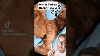 The Sun Causes This! - WORLDS DARKEST BLACKHEAD REMOVAL -  #shorts