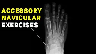 Accessory Navicular Syndrome Exercises by a Foot Specialist