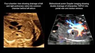 4D STIC for detecting total anomalous pulmonary venous connection with double drainage