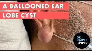 A Ballooned Earlobe Cyst