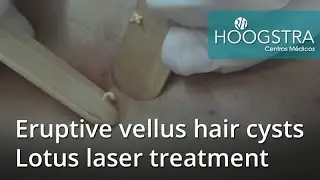 Eruptive vellus hair cysts - Lotus laser treatment (20234)