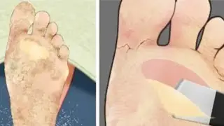 (Asmr) remove thick dead skin cells and calluses / animation 