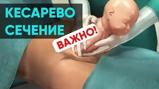 Кесарево сечение. Ника Болзан