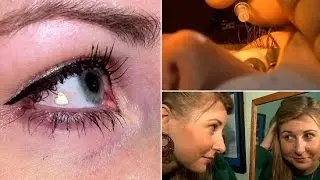 Woman Gets Platinum Jewel Implanted in Her Eye to Make Herself Unique- Lucy Luckayanko