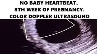 NO BABY HEARTBEAT. 8TH WEEK OF PREGNANCY. COLOR DOPPLER ULTRASOUND #ultrasound #baby #pregnant