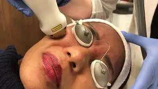 ICON 1540 Fractional Laser Treatment -  Dr. Anthony Youn