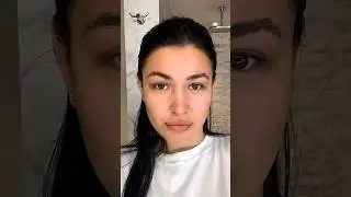 Блефаропластика до после