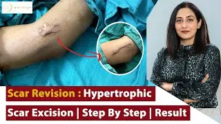 Hypertrophic Scar Excision | Full Surgery | Result | Dr. Shalu Punj