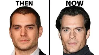 Is Henry Cavill's Face All Natural? | Plastic Surgery Analysis