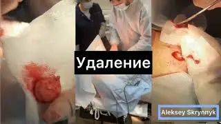 Удаление образования мягких тканей ягодицы.